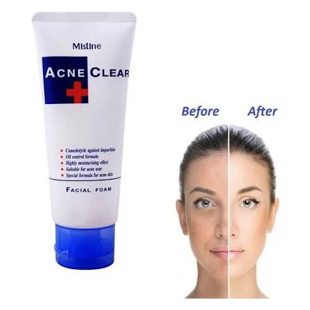 Hydroskin Plus Acne Clean Facial Foam (80gm)
